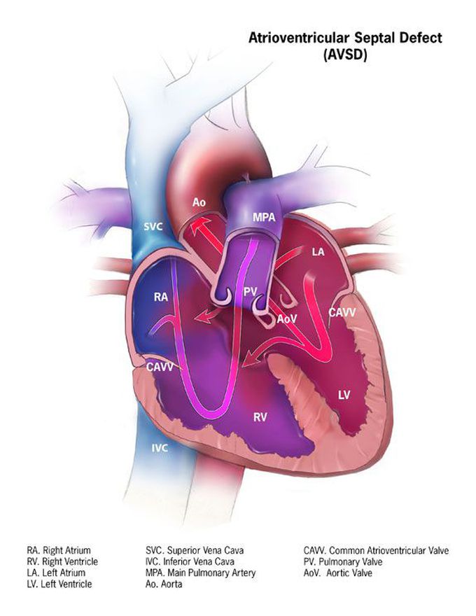 Atrioventricular septal defect