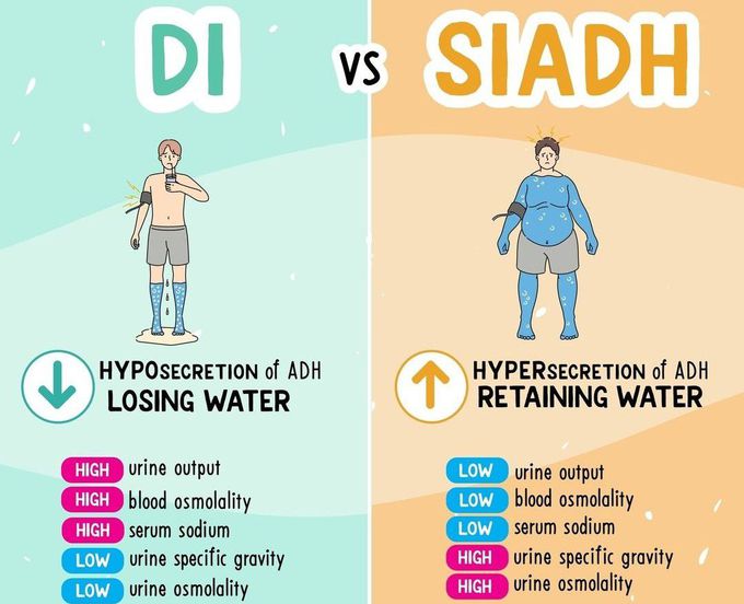 DI Vs SIADH