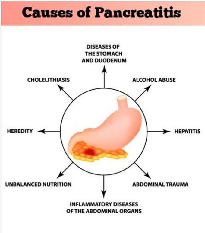 Cause of Pancreatitis