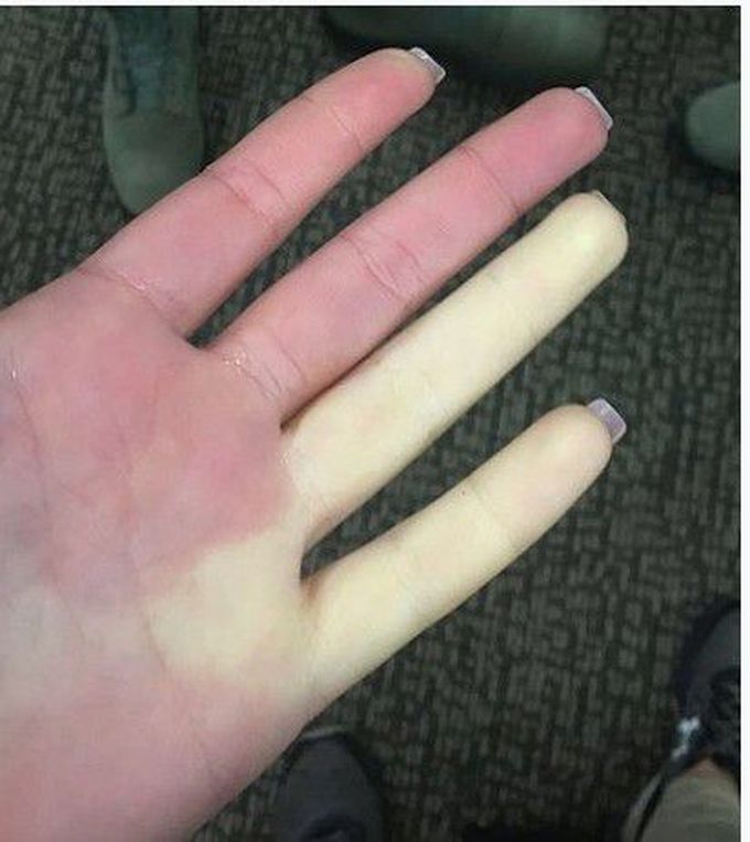 Raynaud's phenomenon