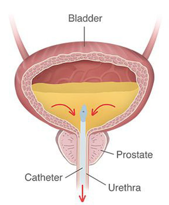 Treatment of urinary retention