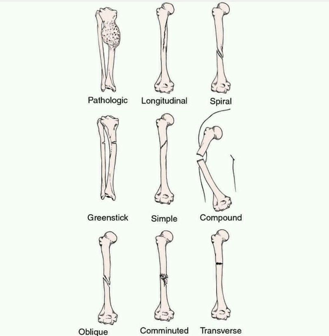 Type of bone fracture - MEDizzy