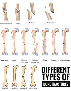 Different type of bone fracture - MEDizzy