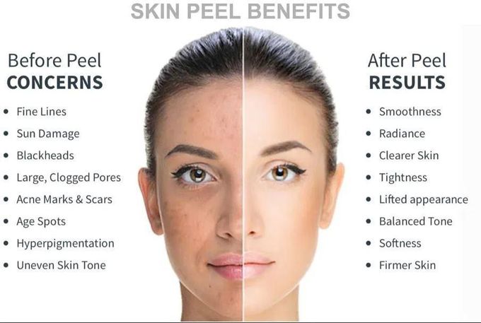 Results of chemical peel