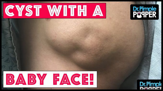 An Amazing Baby Faced Cyst!