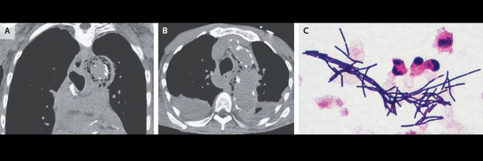 Emphysematous Aortitis