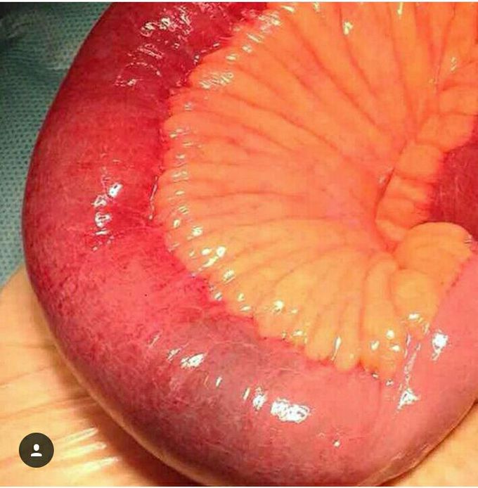 Complication of Cholithiasis.