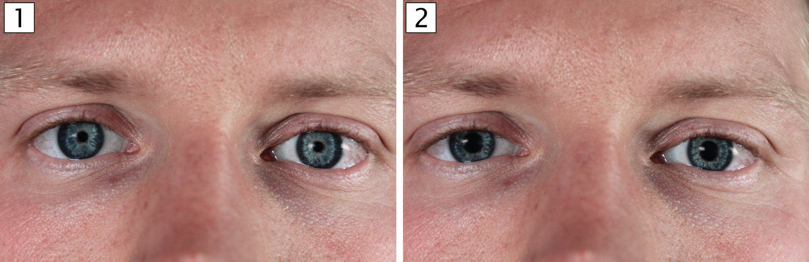 causes-of-pinpoint-pupils-medizzy