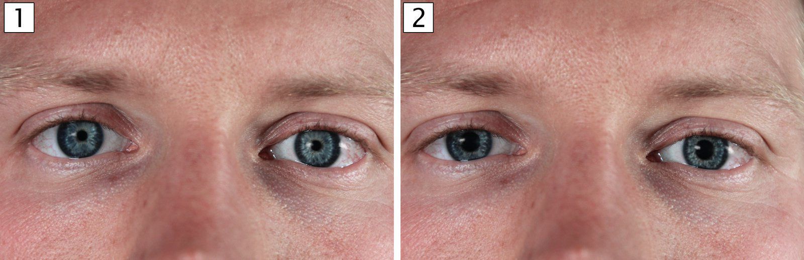 Causes Of Pinpoint Pupils MEDizzy