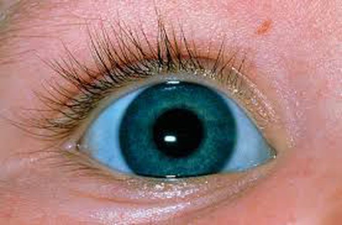 Blue sclera