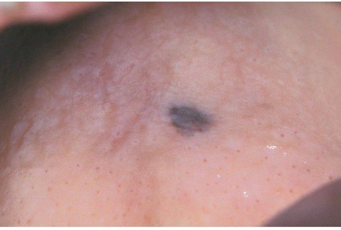 Oral Melanoma.