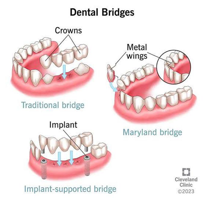 Dental Bridges