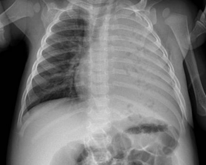 Cavitating pneumonia

The chest xray shows complete opacification of the left hemithorax with numerous small lucencies throughout. Findings consistent with cavitating bacterial pneumonia