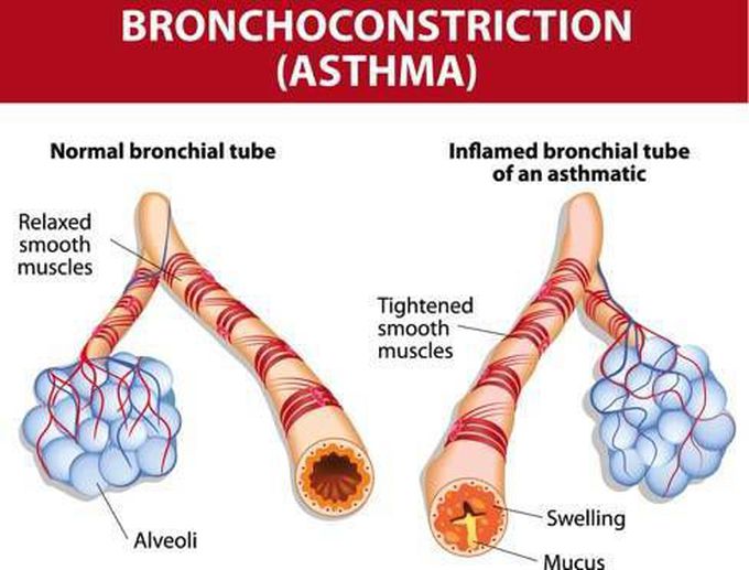 Asthma