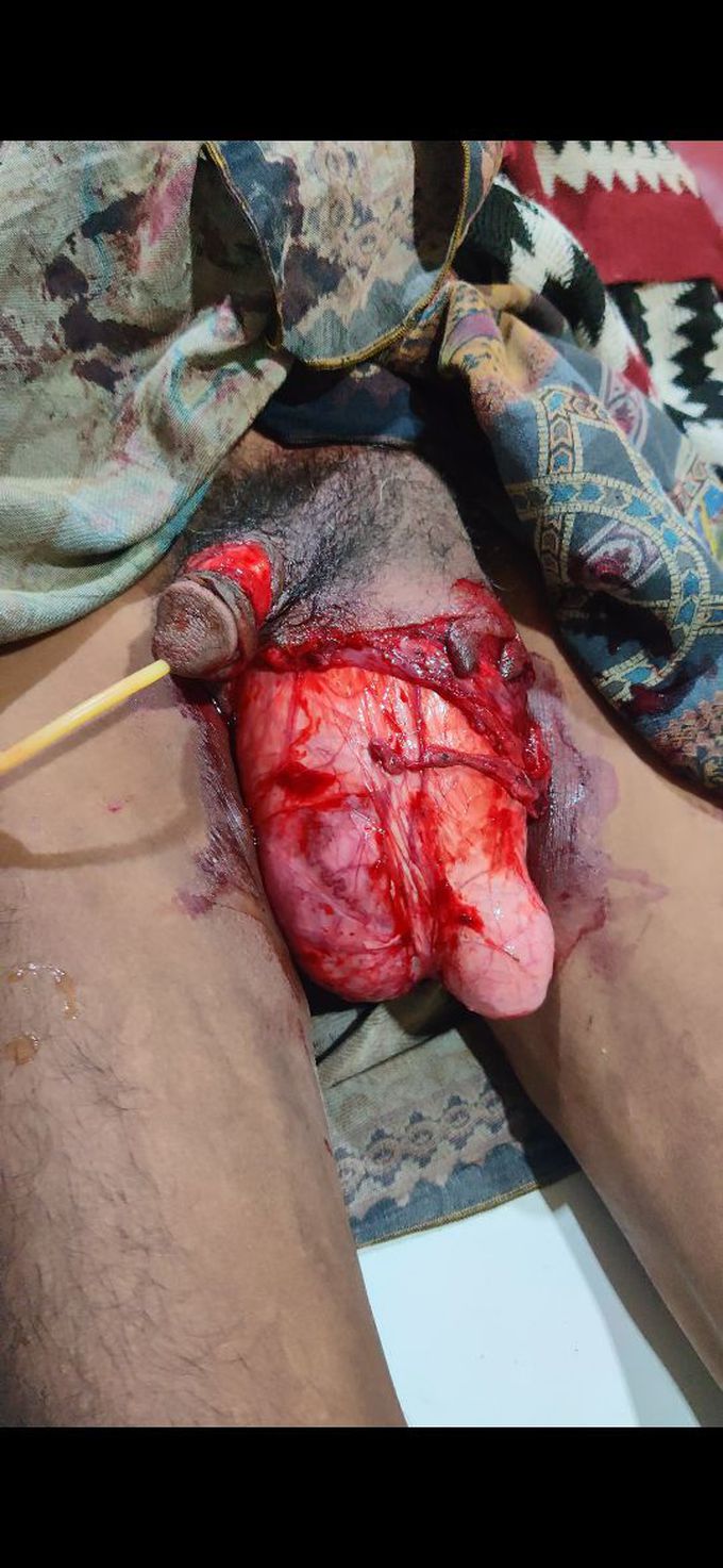 Degloving injury of Scrotum