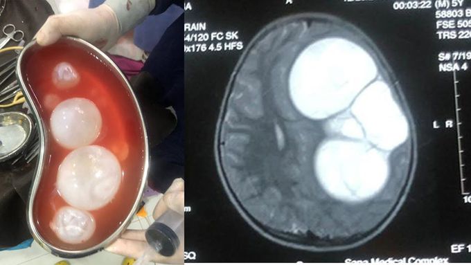 Multiple hydatid cysts removed from the brain
