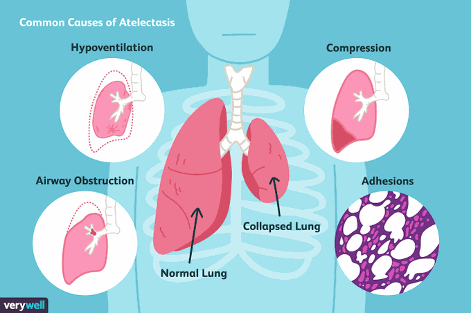 Atelectasis symptoms