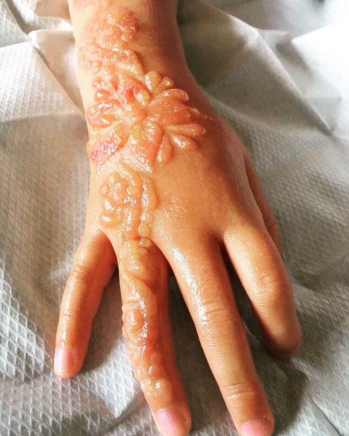 Chemical burn after black henna tattoo !!