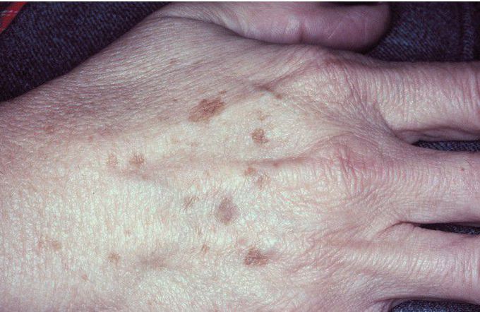Actinic Lentigines