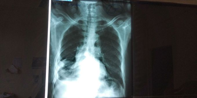 Chest xray