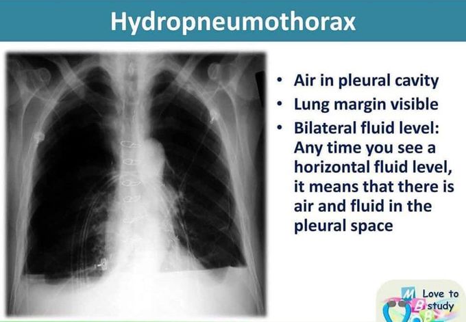 Hydropneumothorax CXR