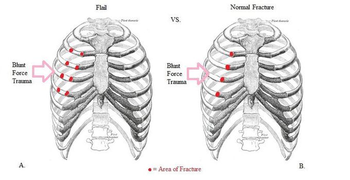 flail chest VS rib fracture