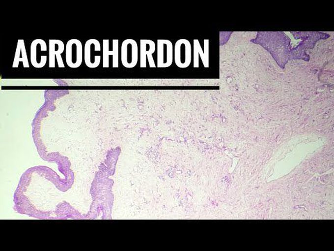 Fibroepithelial polyps - (Acrochordon)