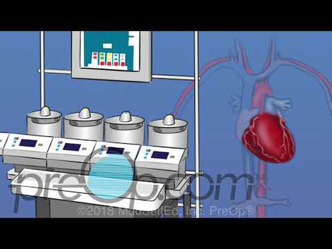On Pump Coronary Artery Bypass Graft(CABG)