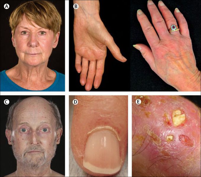 Diagnostic Criteria of Systemic Sclerosis