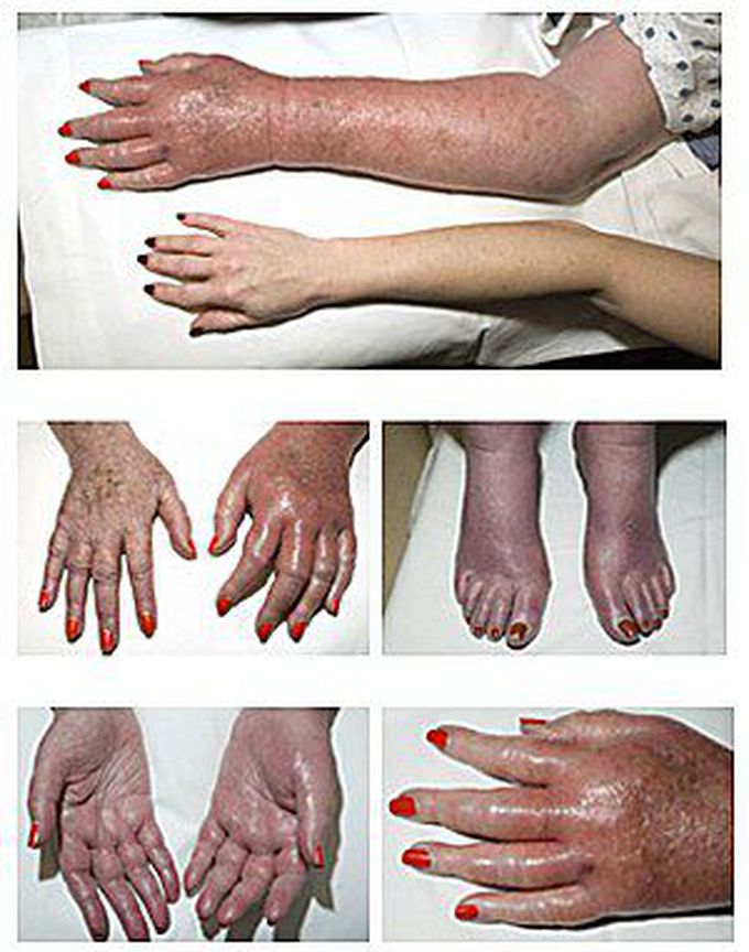 Erythromelalgia