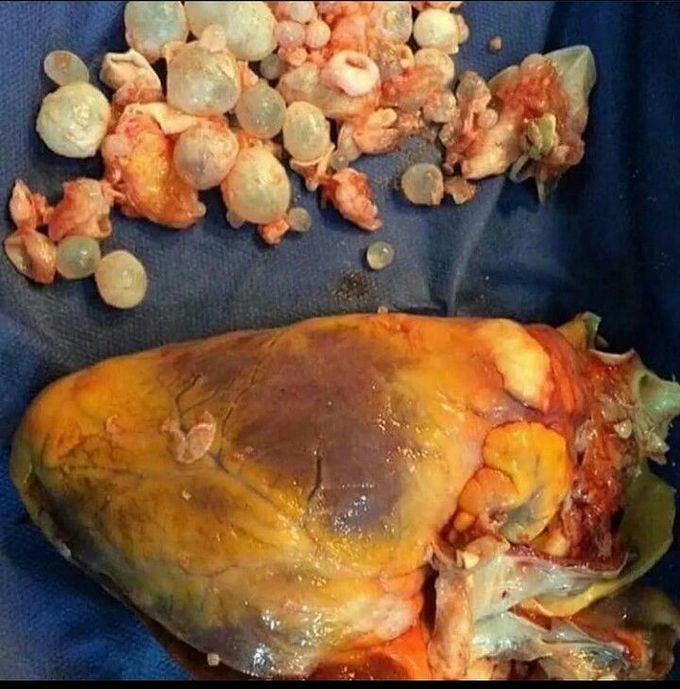 Hydatid cyst in heart!