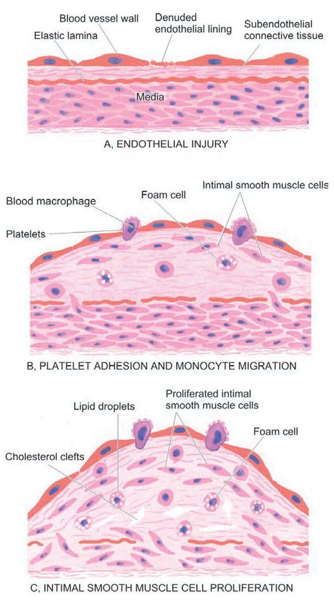 Pathogenesis of atherosclerosis