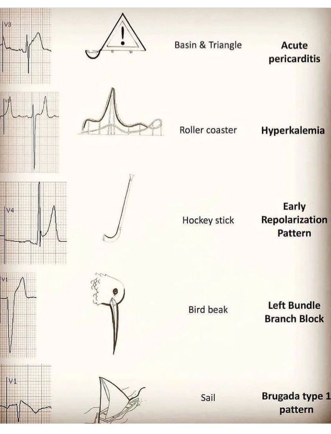 ECG changes