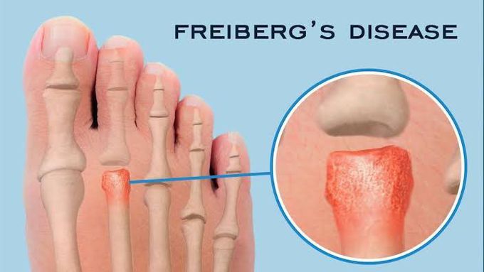 What is Freiberg disease