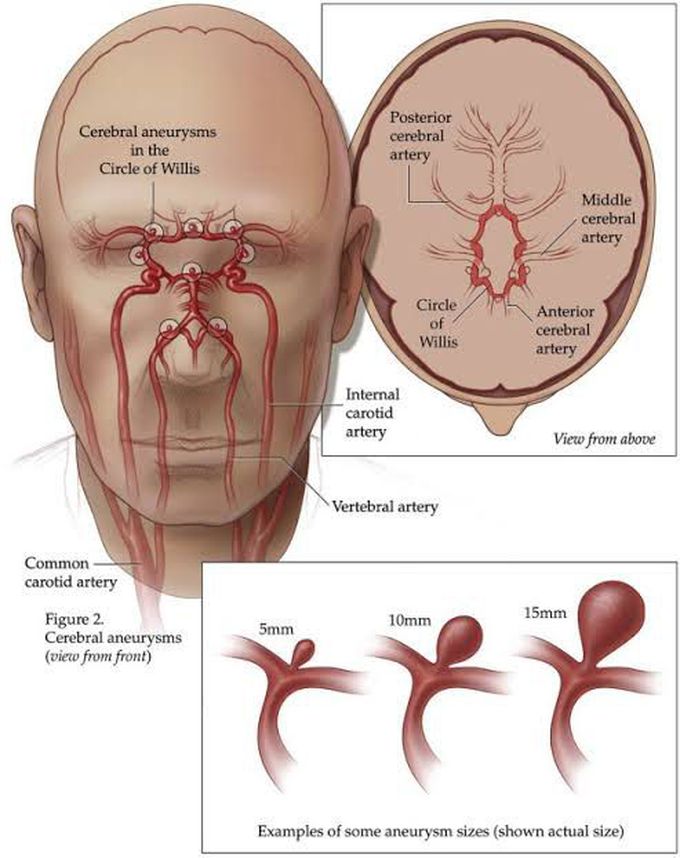 Brain aneurysm