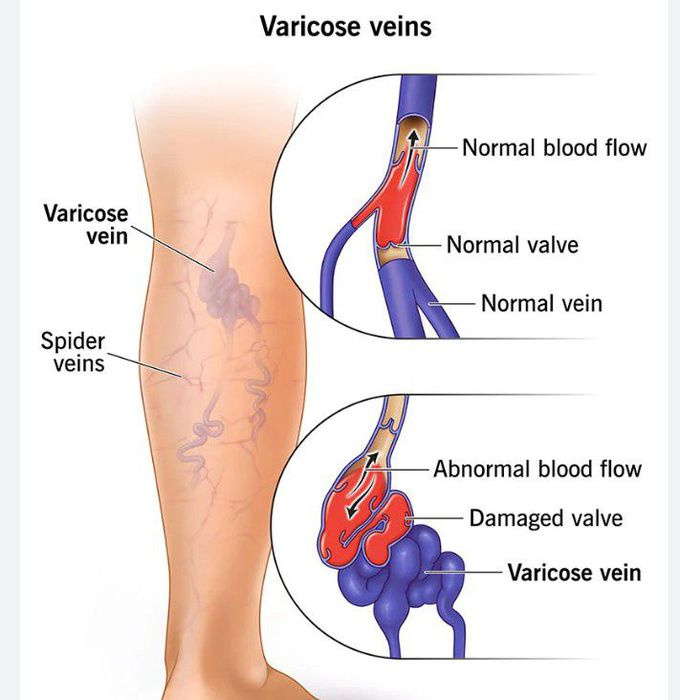 Varicose veins