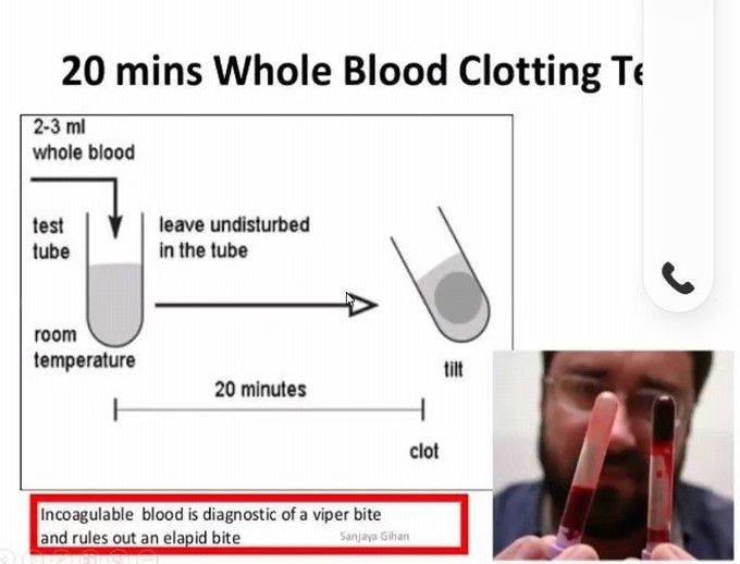 For snake bite ...20 mins of whole blood clotting test