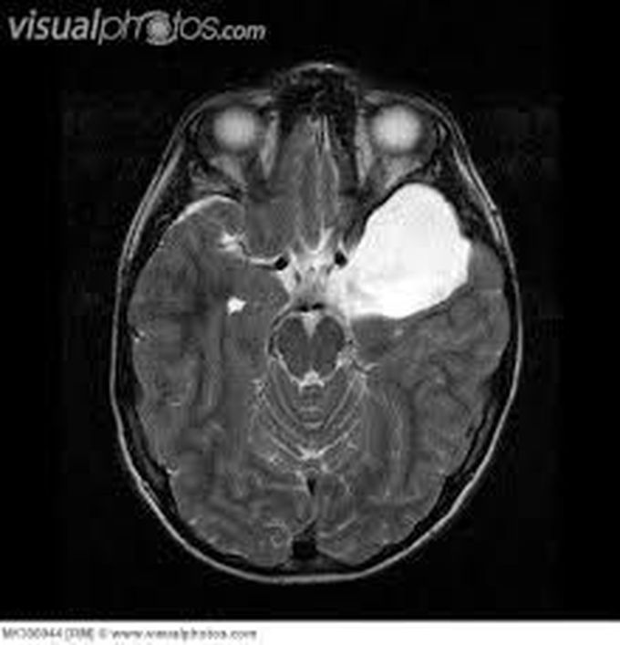 Arachnoid Cyst