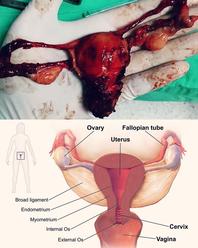 Here is an interesting shot of ovaries, fallopian tubes, and uterus following a procedure called hysterectomy. 
