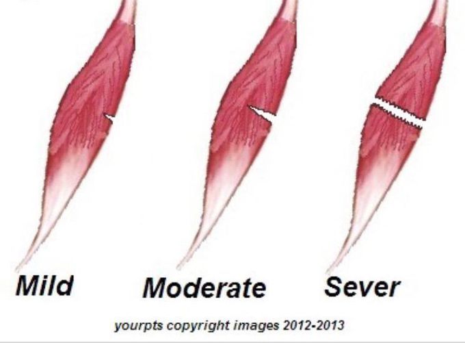 Muscle tear