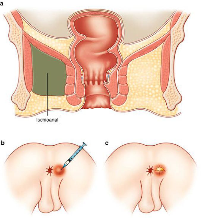 Anorectal abscess