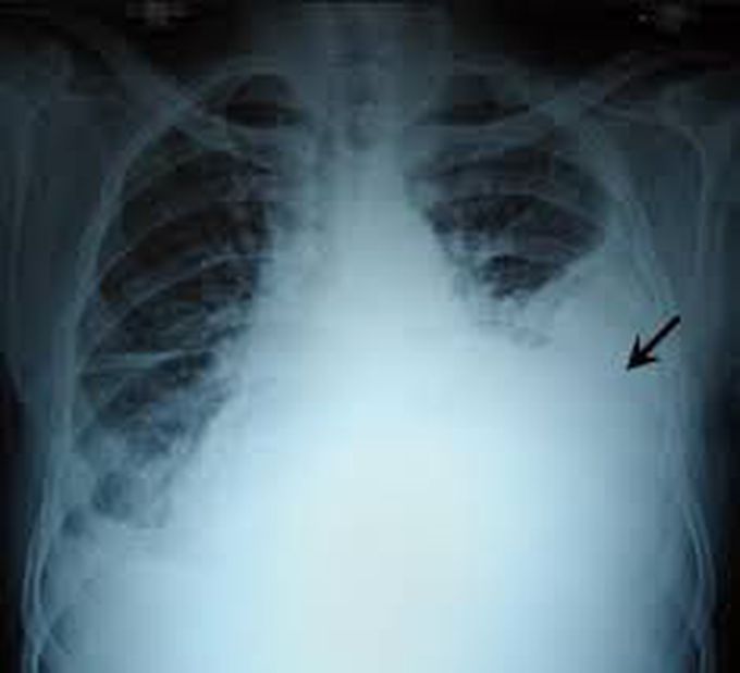 Massive hemothorax symptoms