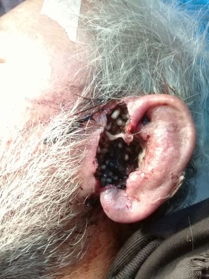 A 50 years old man with painful swelling of left eye and larva grows in his ear and sepration of his ear 
