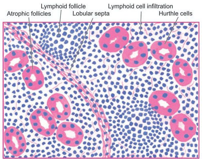 Hashimoto’s thyroiditis