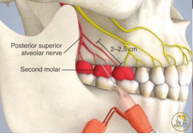 Superior Alveolar Nerve Block