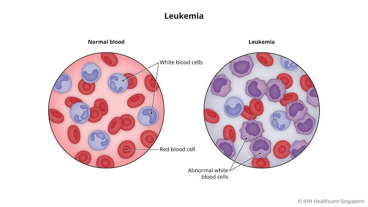 Leukemia - MEDizzy