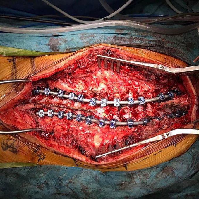 Intraoperative view of scoliosis surgery!