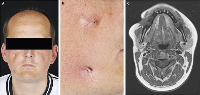 Orofacial Fistulae Associated with Crohn’s Disease