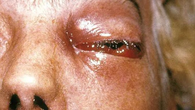 Another severe problem for india😞😞"BLACK FUNGUS"or mucormycosis this occurring in patients who are getting cure from covid-19