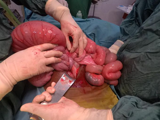 Sigmoid volvulus on redundant sigmoid